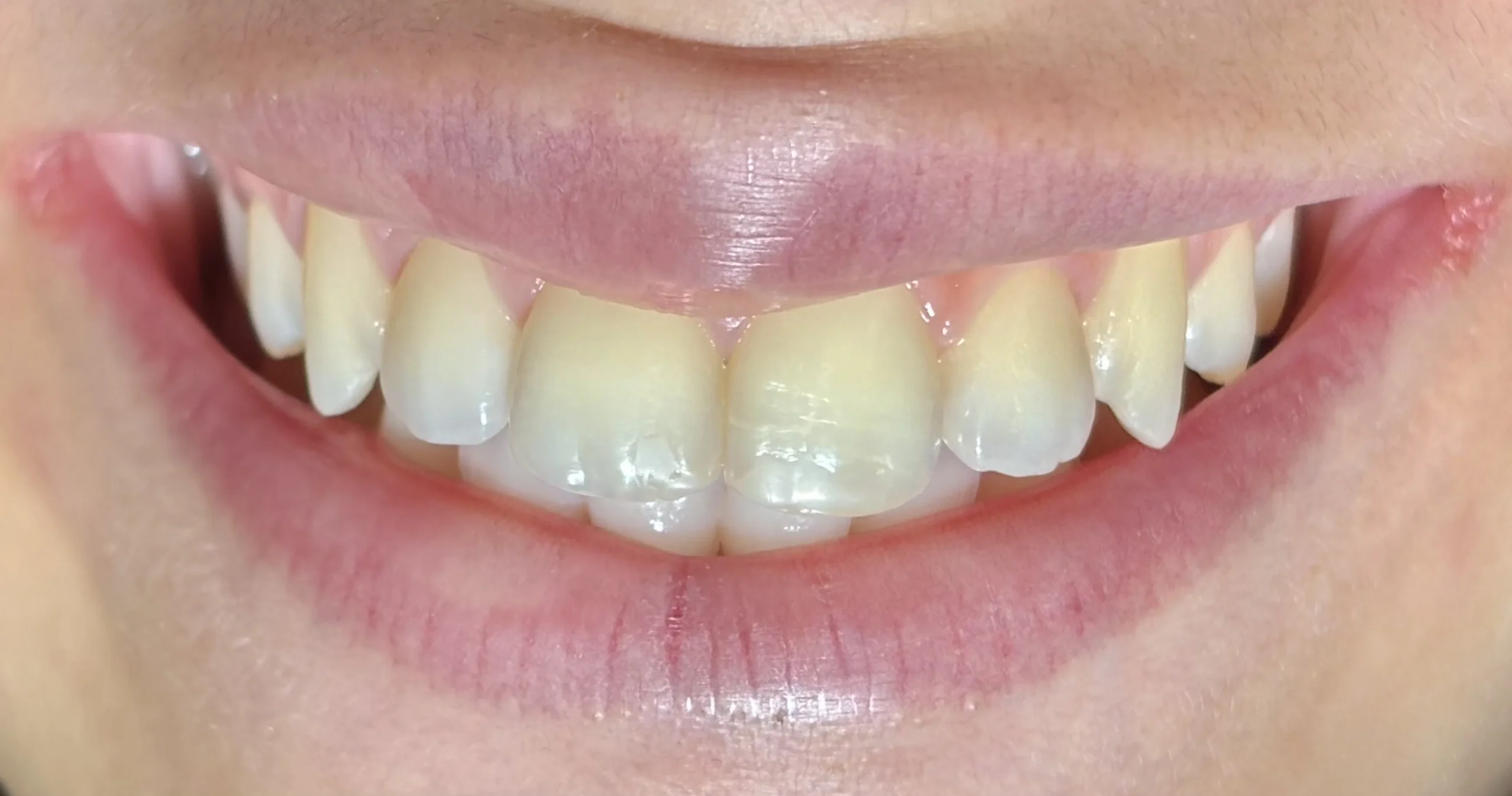 Blanqueamiento antes