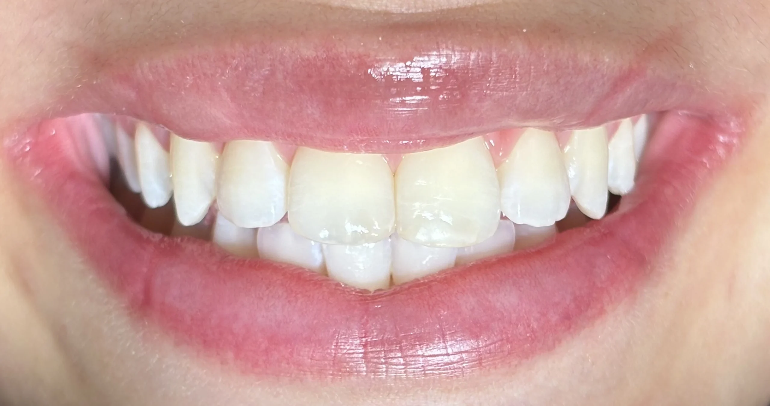 Blanqueamiento despues