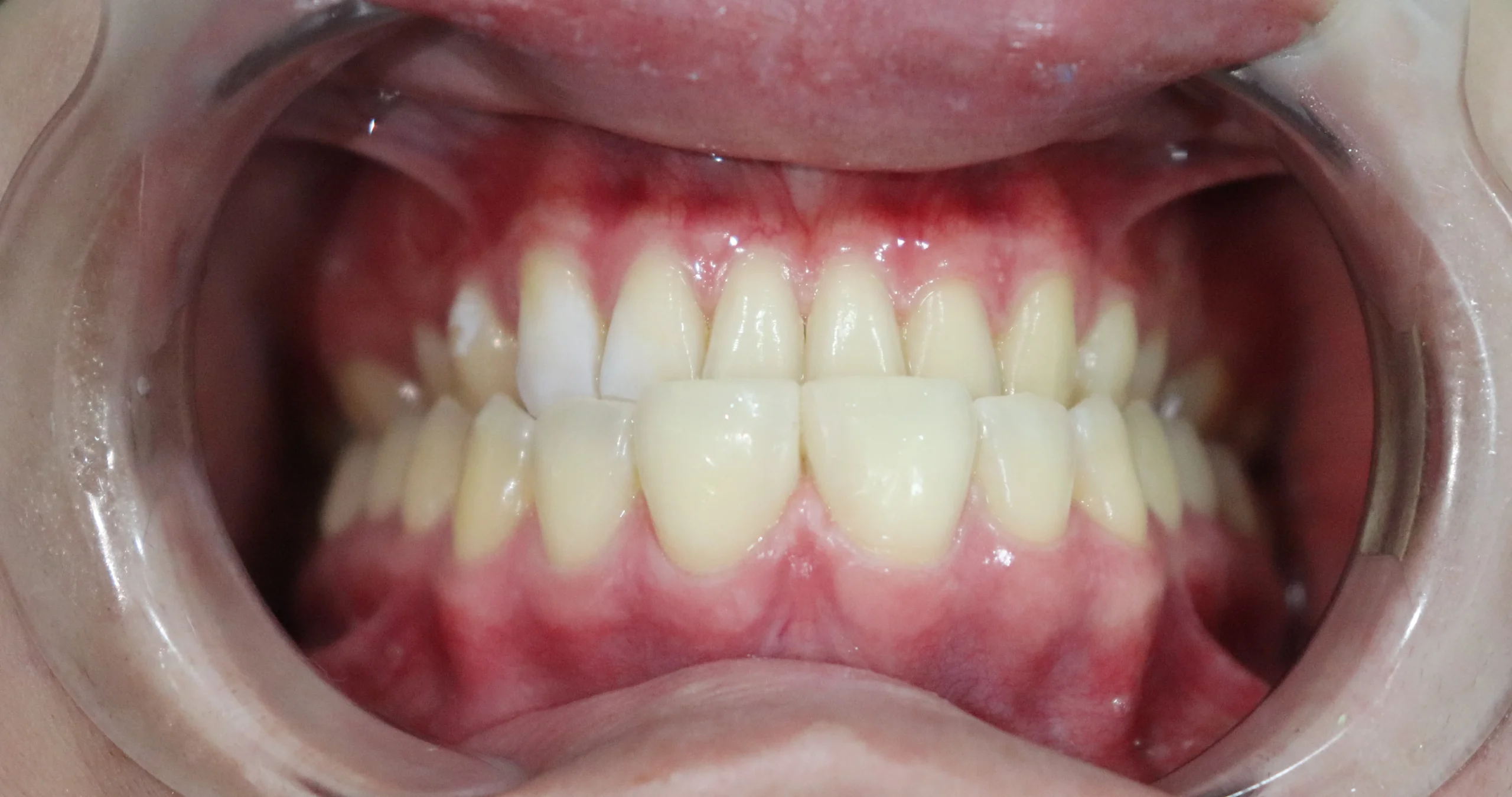 Diastema despues