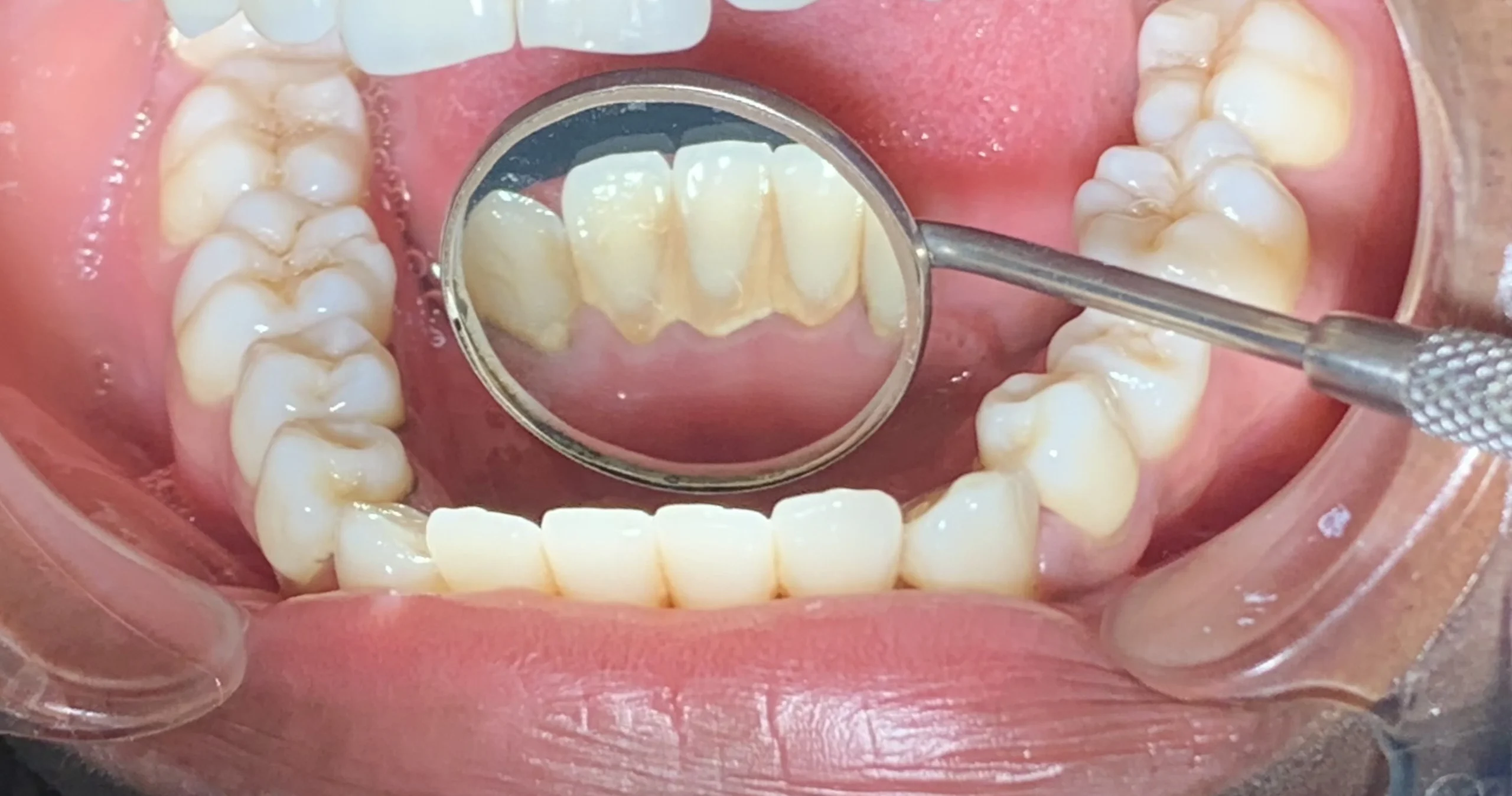 Limpieza Dental antes