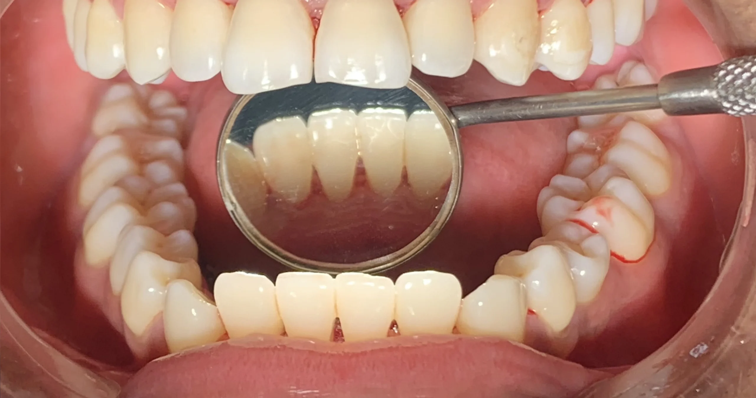 Limpieza dental despues